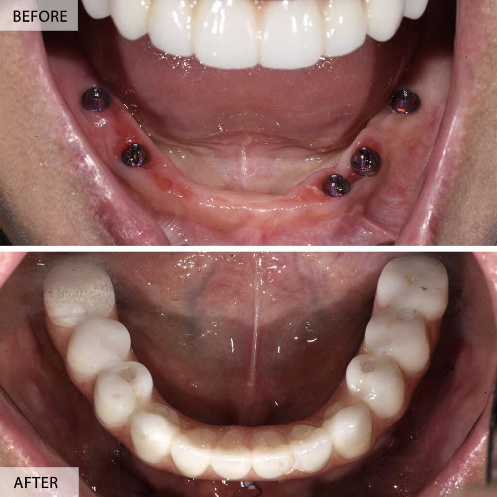 All-on-5 before and after