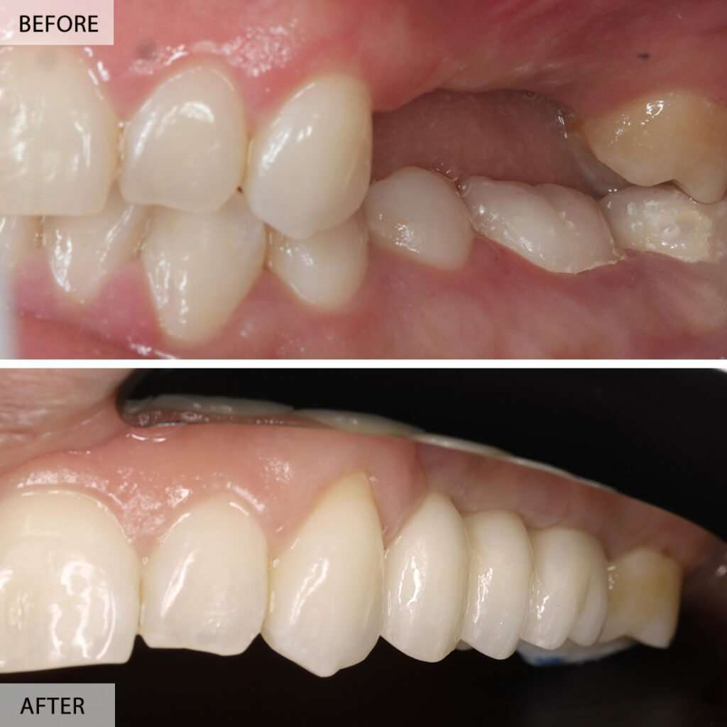 Back teeth dental implants before and after