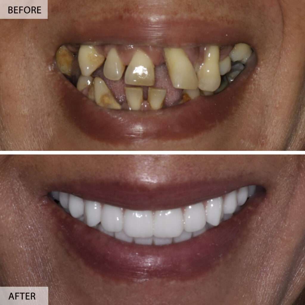 Full mouth implant dental implants before and after