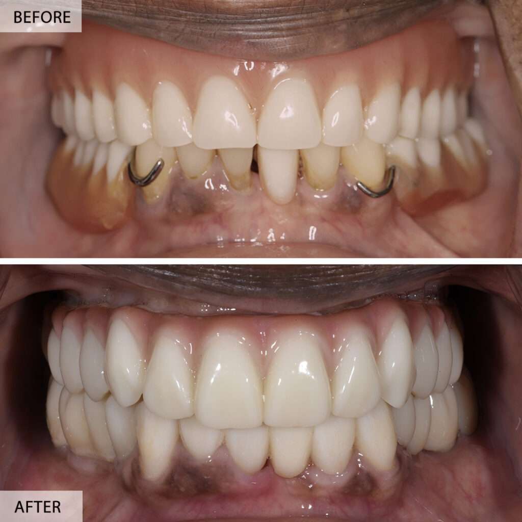 Full mouth rehab before and after