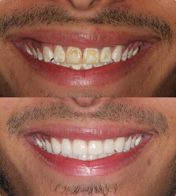 Cosmetic Dentistry | Porcelain Veneers Before and After