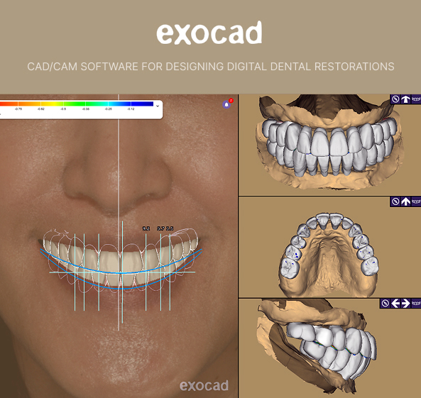 Cosmetic Dentistry | CAD/CAM software for designing digital dental restorations