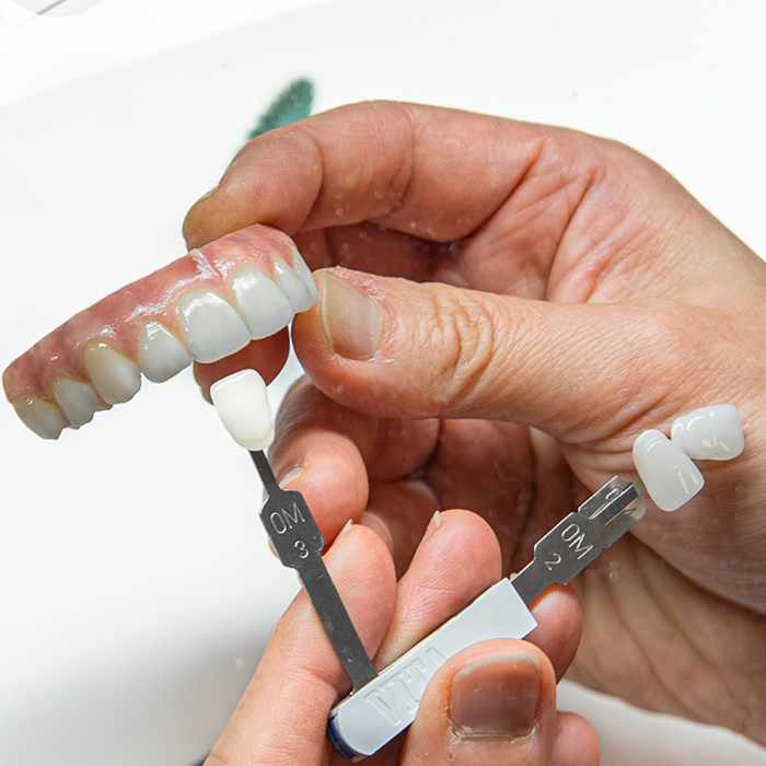 What Are Porcelain Veneers