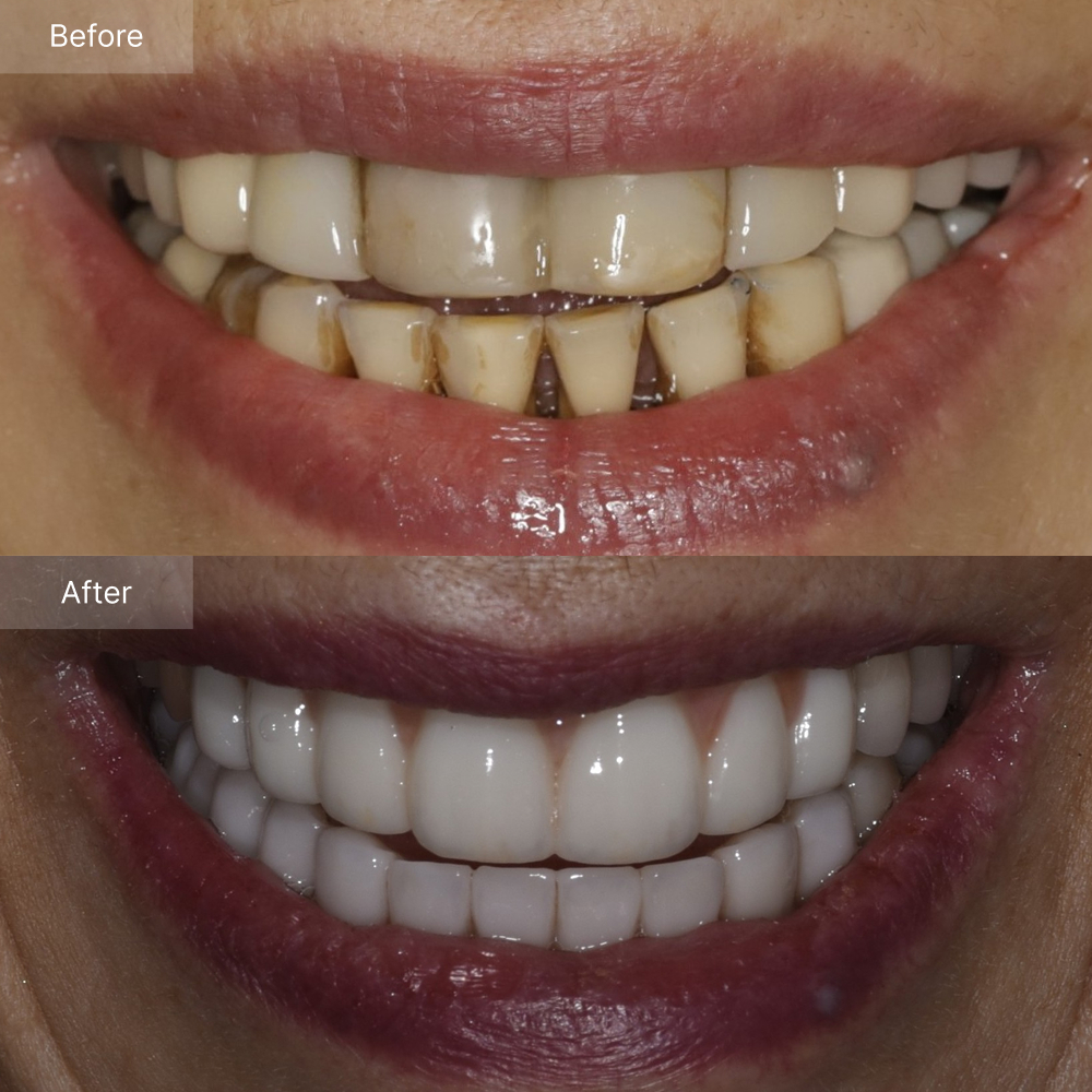 Full mouth reconstruction before after result case 1