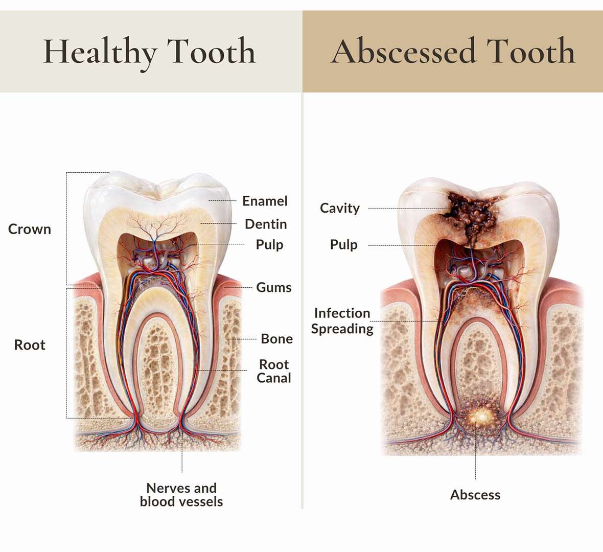 Comparison of healthy tooth anatomy and abscessed tooth requiring root canal treatment showing pulp infection and periapical abscess as part of endodontics care at NYC Dentistry Center in Midtown Manhattan near Grand Central