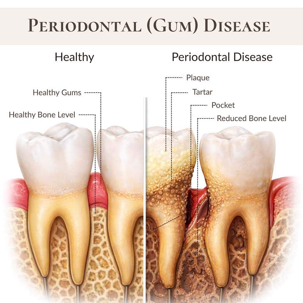 Illustration showing healthy gums and bone level compared to advanced periodontal (gum) disease with plaque, tartar buildup, gum pocket formation, and reduced bone level at NYC Dentistry Center in Midtown Manhattan, New York (10017).
