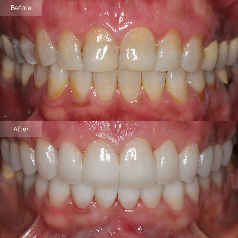Porcelain veneers before after result case 4