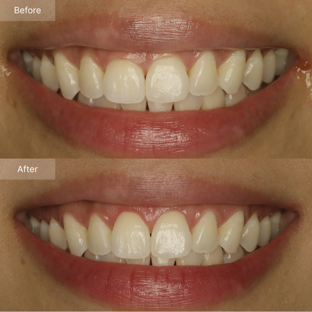 Smile makeover before after result case 2