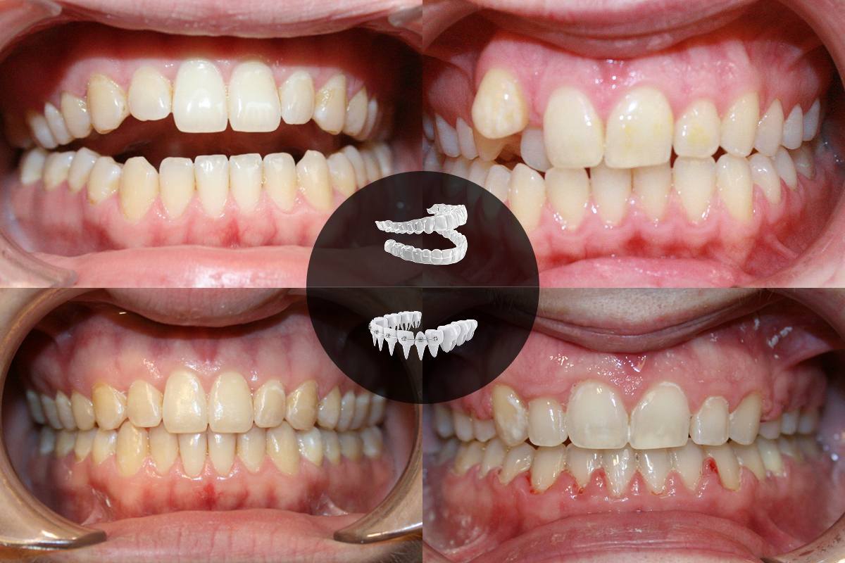 Orthodontics Invisalign