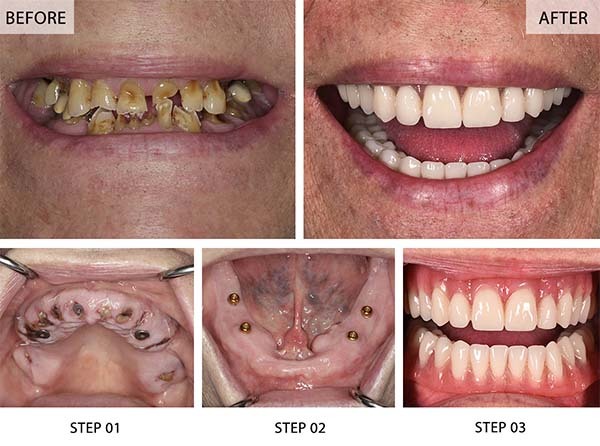 Before and after full-arch smile restoration with All-on-4 dental implants showing treatment steps and final results