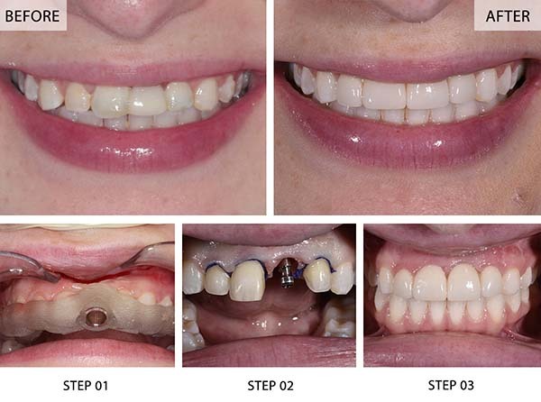 Front tooth dental implant before and after results with step-by-step procedure at NYC Dentistry Center Midtown East Manhattan