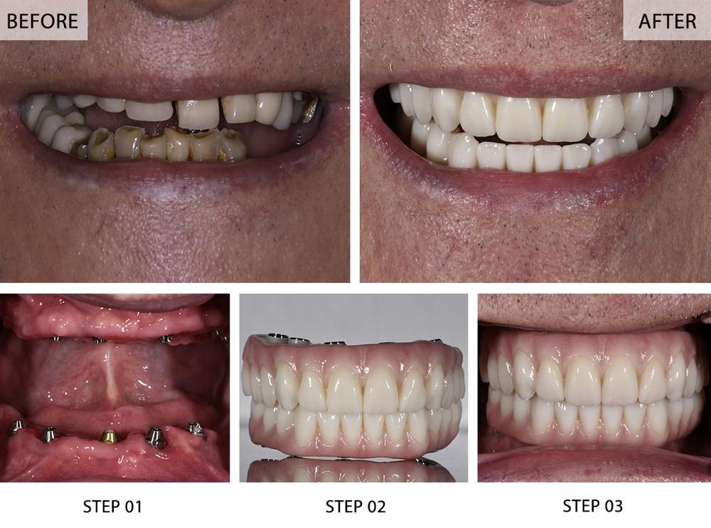 Full mouth dental implants before and after with step-by-step procedure showing implant placement, prosthetic teeth, and final smile restoration at NYC Dentistry Center
