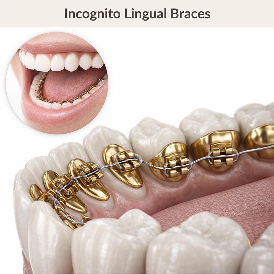 Incognito lingual braces placed on the inner surface of the lower teeth during orthodontic treatment at NYC Dentistry Center