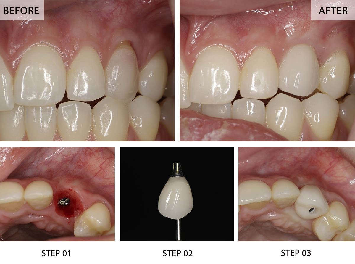 Single tooth dental implant before and after showing implant placement and final crown restoration at NYC Dentistry Center in Midtown Manhattan