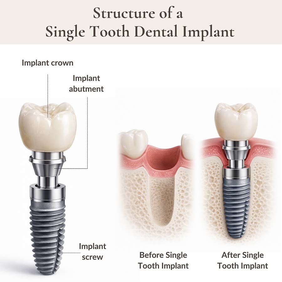 single tooth dental implant showing crown abutment and titanium implant screw replacing a missing tooth in Midtown Manhattan NYC