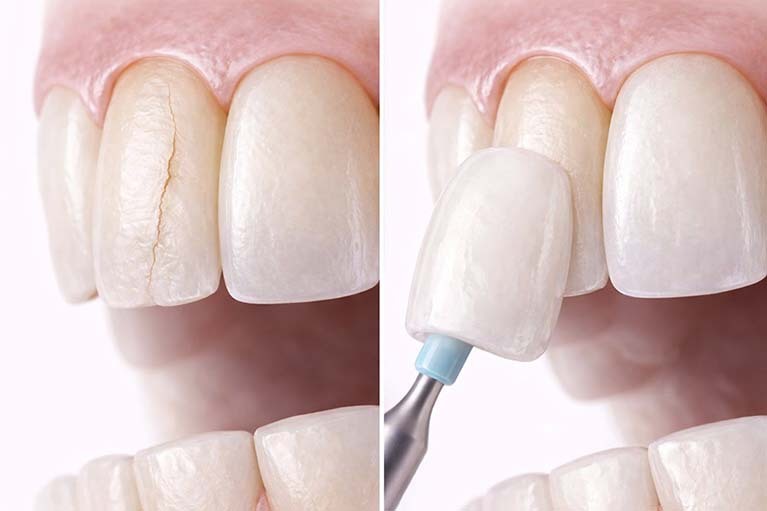 Cracked front tooth restored with custom porcelain veneer preserving natural tooth anatomy by NYC Dentistry Center