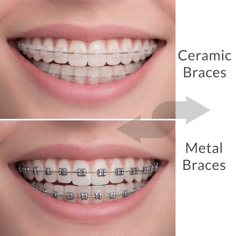 Ceramic braces vs metal braces comparison with tooth colored brackets and traditional metal brackets for teeth alignment