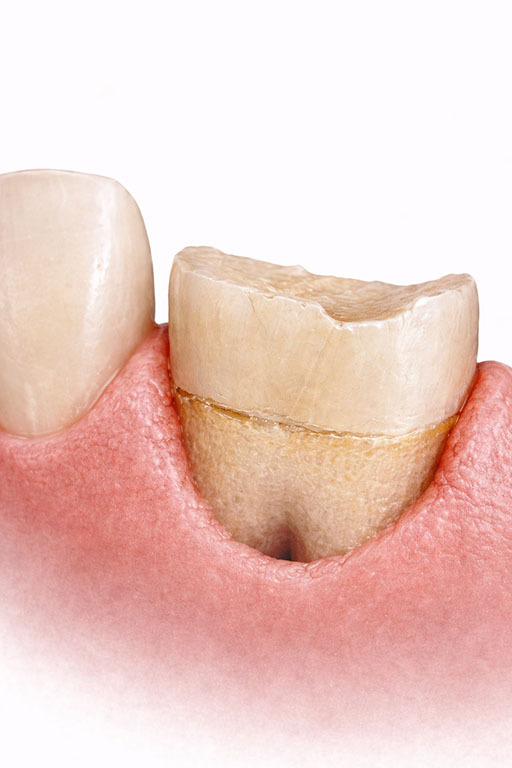 Broken tooth near gum line in NYC requiring crown lengthening to expose tooth structure for dental crown restoration