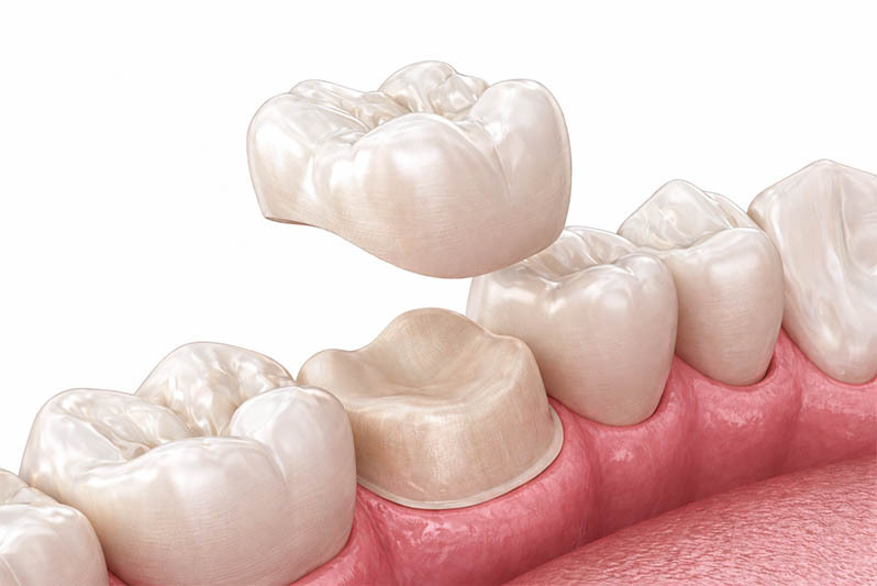 Dental crown procedure showing tooth preparation and placement of ceramic crown restoring damaged molar