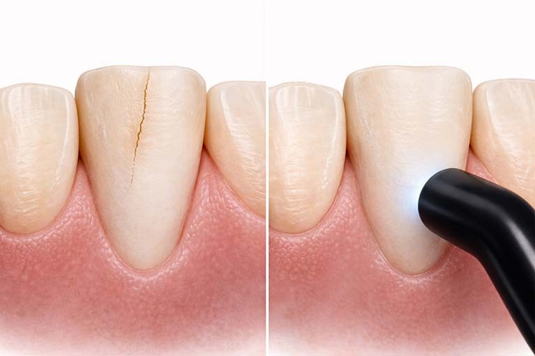 Before and after dental bonding for a chipped front tooth using tooth-colored composite resin, showing natural-looking crack repair at NYC Dentistry Center