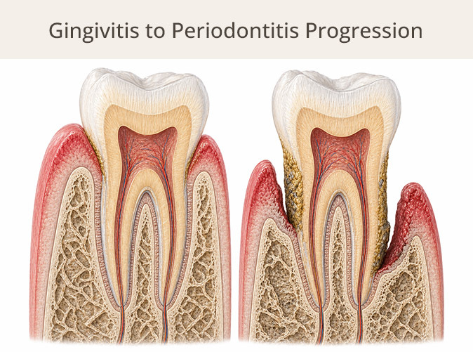 Progression from gingivitis to periodontitis showing gum inflammation and bone loss in Midtown East NYC dental care
