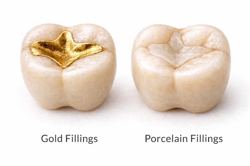Gold and porcelain inlay onlay indirect dental fillings on molar teeth NYC dental restoration comparison