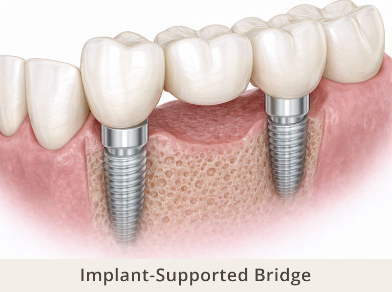 implant supported dental bridge with crowns attached to dental implants replacing multiple missing teeth