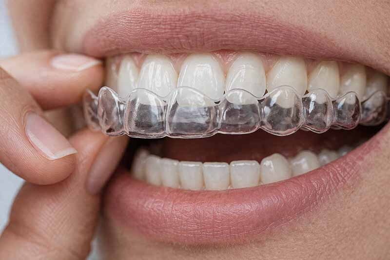 Invisible braces clear aligners on teeth Midtown East NYC discreet orthodontic treatment for adults and teens
