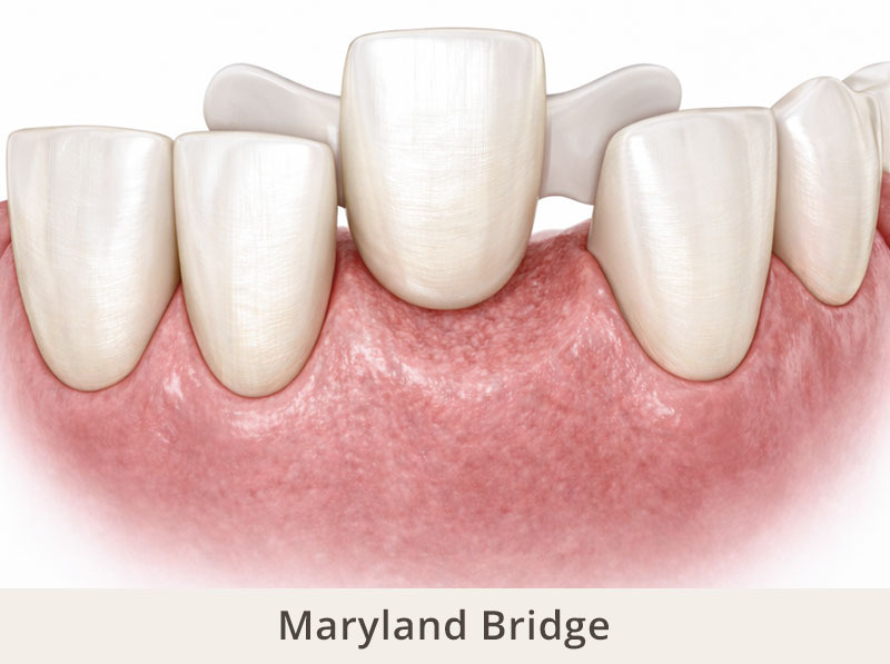 maryland dental bridge with resin bonded wings attached to adjacent teeth supporting a pontic