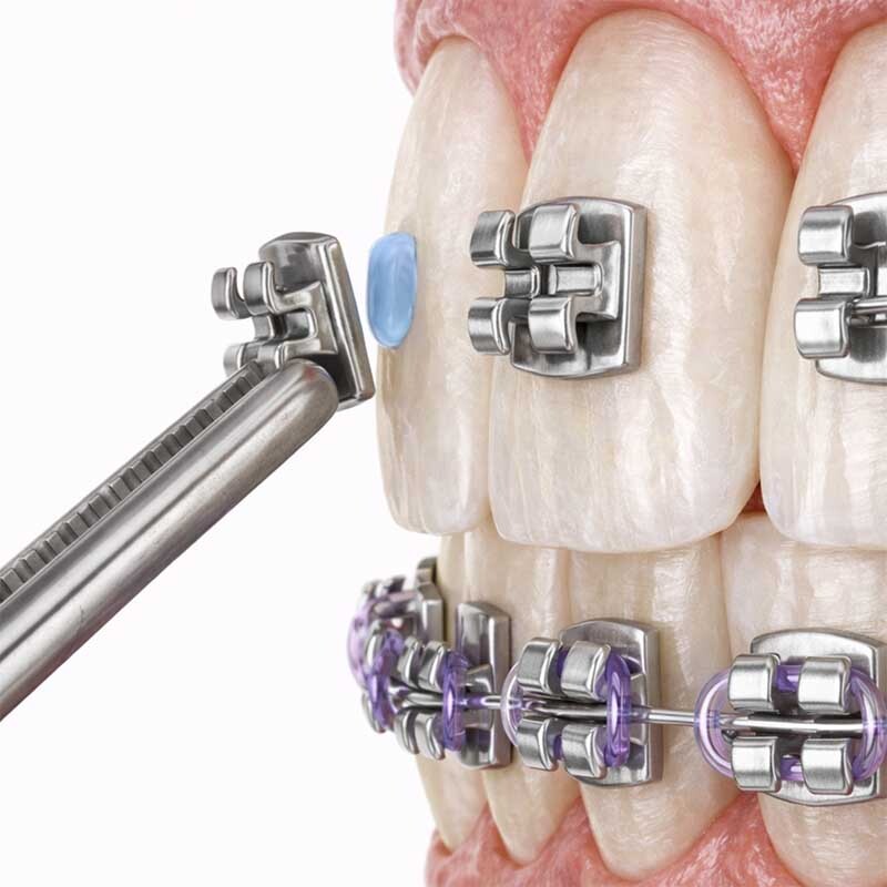Close-up of metal braces with brackets archwire and elastic ligatures during orthodontic treatment in NYC