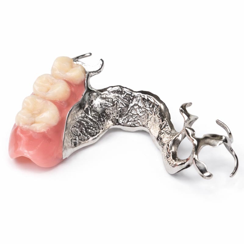 metal framework partial denture replacing missing teeth with removable dental prosthesis in Midtown Manhattan NYC