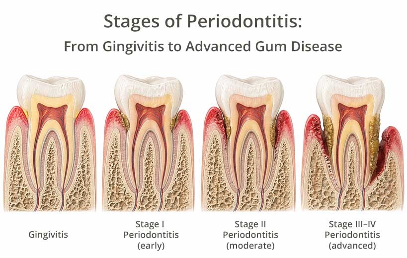 Stages of periodontitis from gingivitis to advanced gum disease showing progression and bone loss in Midtown East NYC dental care