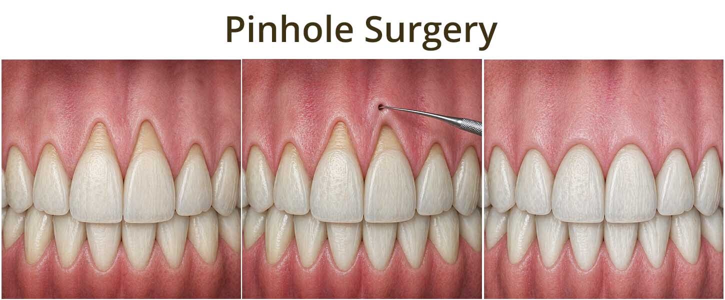Pinhole Surgical Technique (PST) showing minimally invasive gum recession treatment with gentle repositioning of gingival tissue over exposed tooth root without incisions