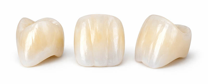 Porcelain dental crown made from lithium disilicate showing natural translucency and lifelike anterior tooth aesthetics