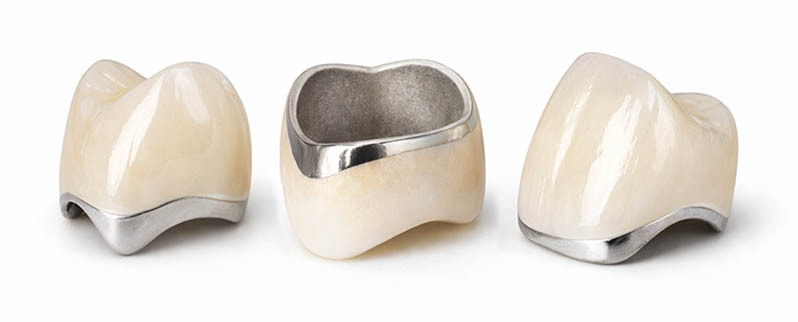 Porcelain fused to metal dental crown showing metal coping and porcelain outer layer for strength and function