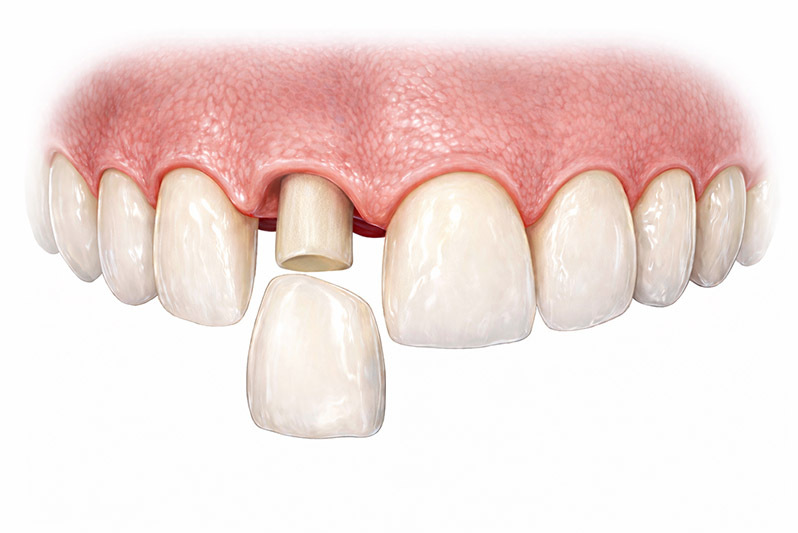 Porcelain same day dental crown being placed over prepared tooth showing precise fit and natural appearance