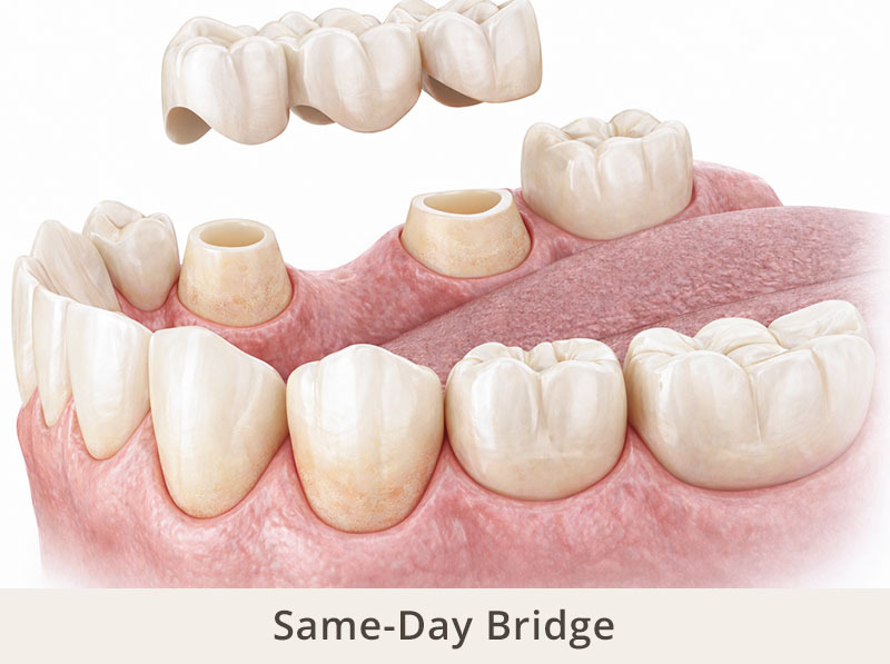 same day dental bridge temporary restoration placed immediately after tooth preparation
