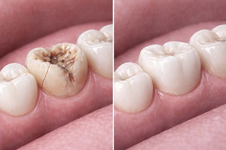 Severely broken molar restored with full coverage dental crown to protect and strengthen tooth structure at NYC Dentistry Center