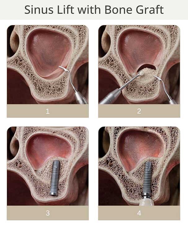 Sinus Lift Bone Graft Procedure Steps Upper Jaw Dental Implant NYC