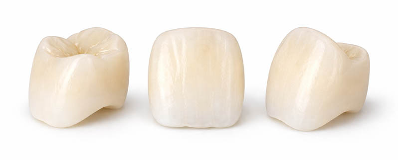 Temporary dental crown made of composite resin used as a short-term provisional restoration after tooth preparation