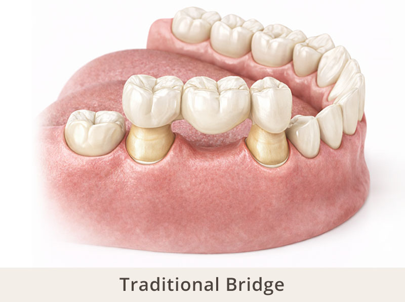 traditional dental bridge with two abutment teeth and pontic replacing a missing tooth in the lower jaw Midtown East NYC
