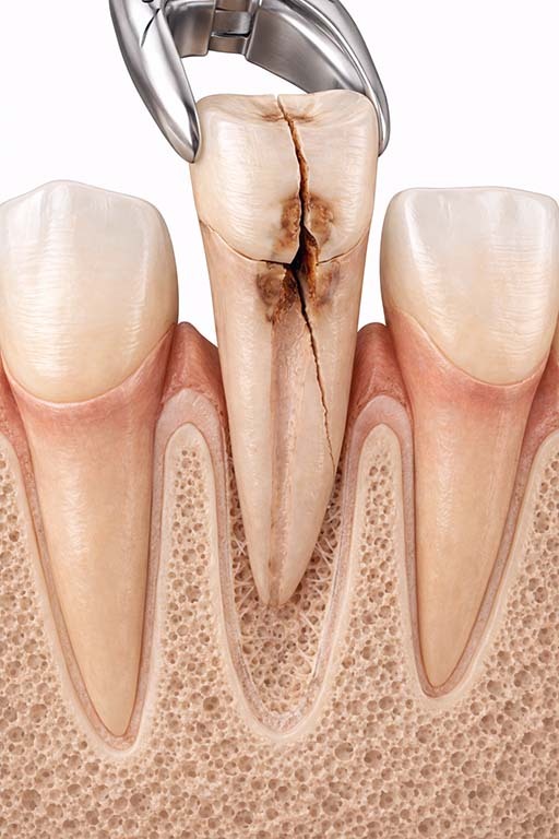 Severely fractured tooth with vertical root fracture being extracted with dental forceps, showing deep crack extending from crown to root at NYC Dentistry Center