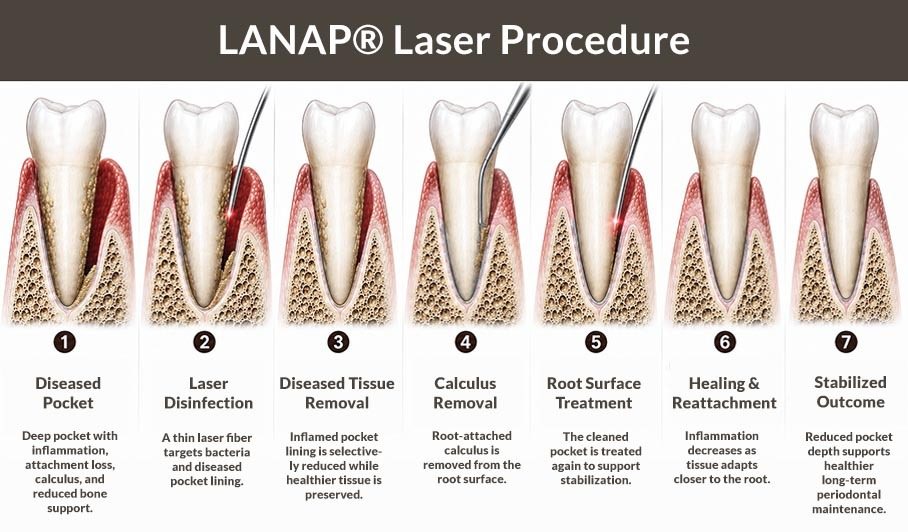 Lanap Laser Procedure Step By Step Midtown Manhattan NYC